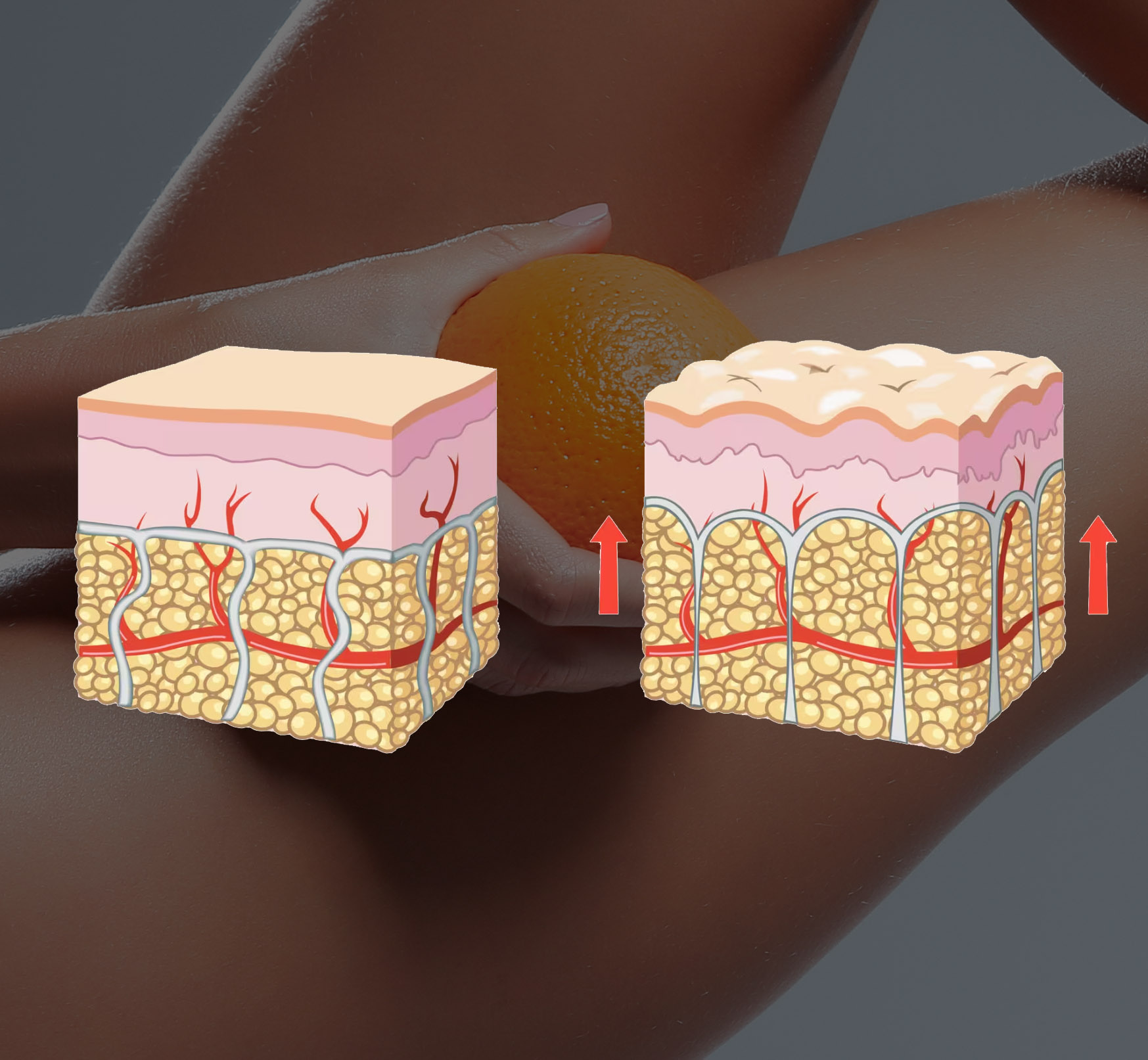 Présentation anatomique de la cellulite